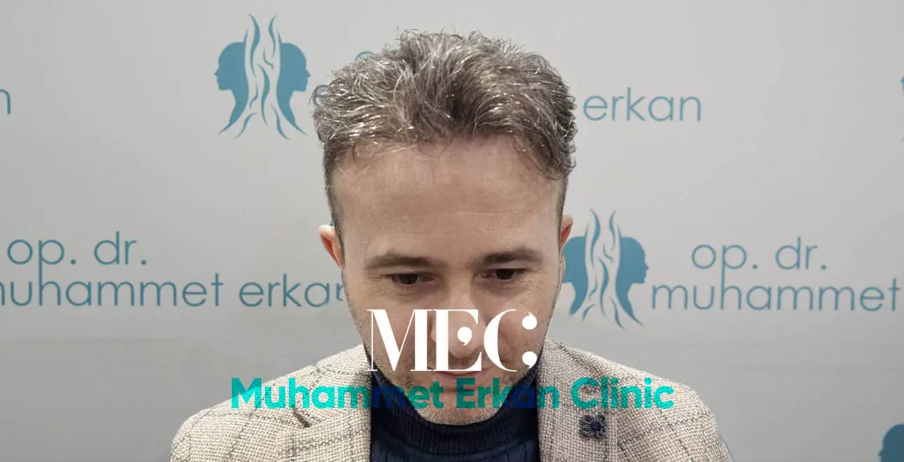 Saç Ekimi Sonrası
